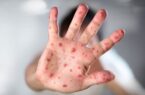 زوایـای آشکار و پنهان ابتـلای کودکان هرمزگان به سرخک